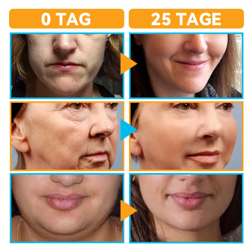 GFOUK Hochintensiver Fokussierter Ultraschall Facelifting Gert